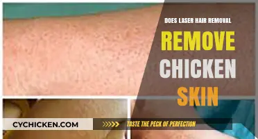 Laser Hair Removal and Chicken Skin: What You Need to Know