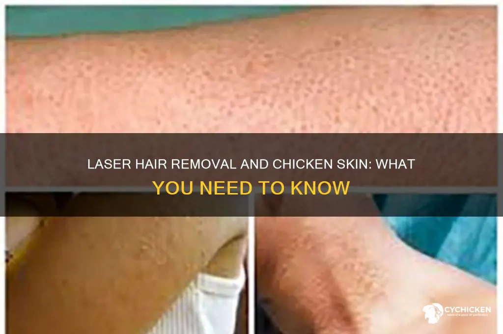 does laser hair removal remove chicken skin
