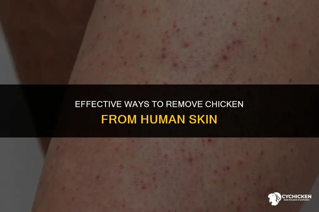 how do you get rid of chicken on a human
