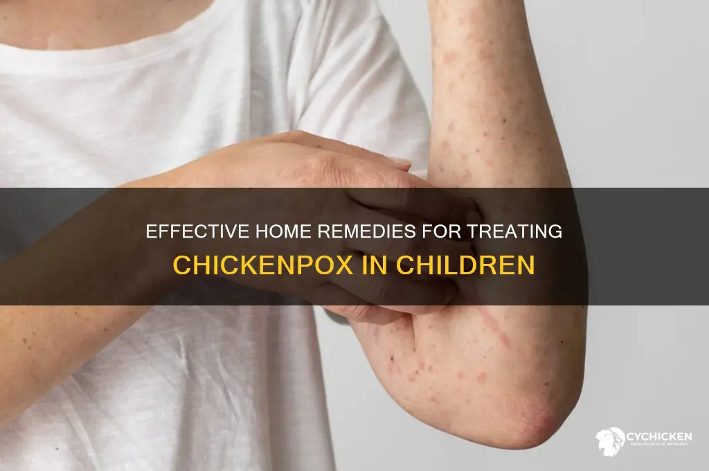 how to treat a kid for chicken pocks