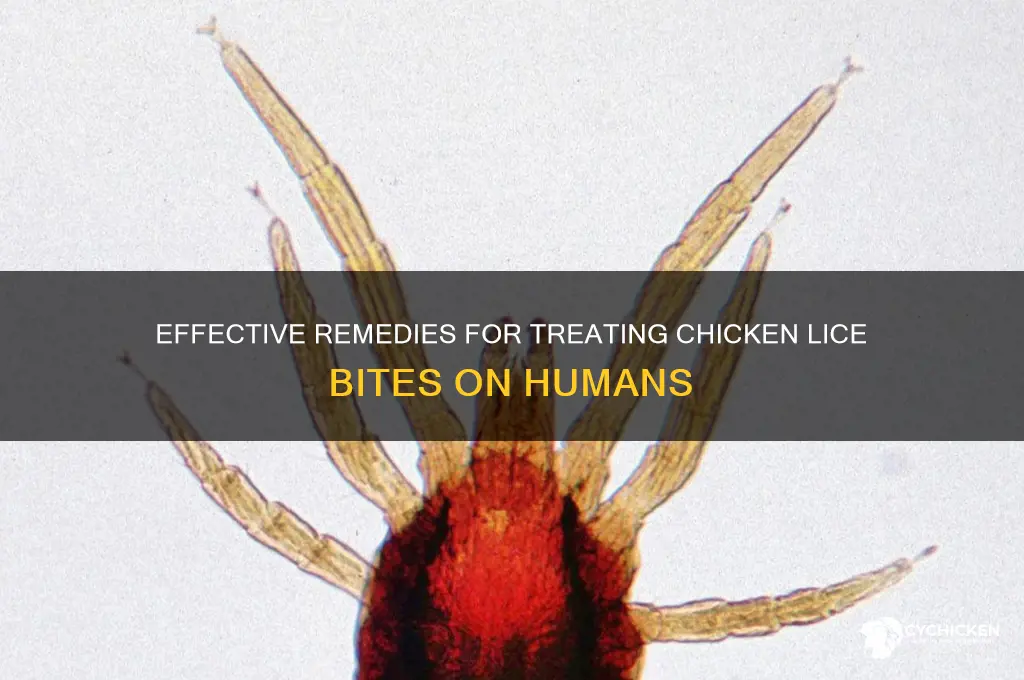 how to treat chicken lice bites on humans
