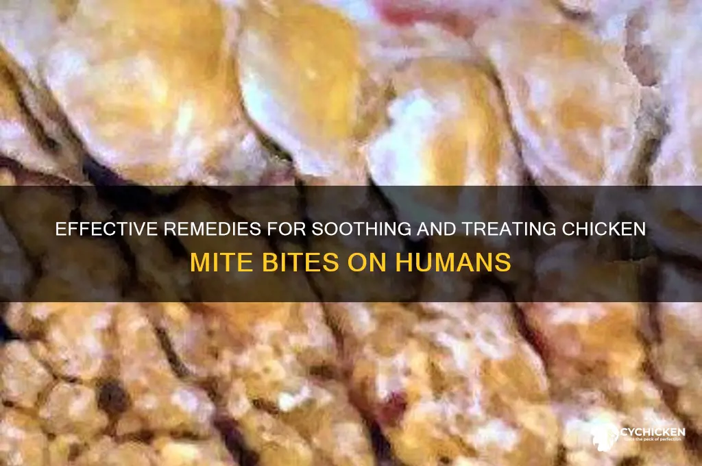 how to treat chicken mite bites on humans