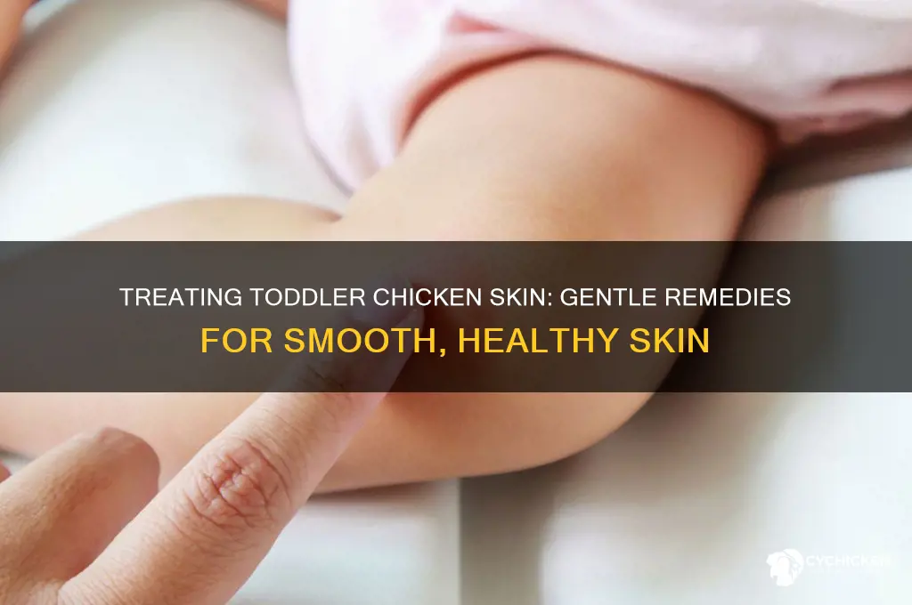 how to treat chicken skin in toddler