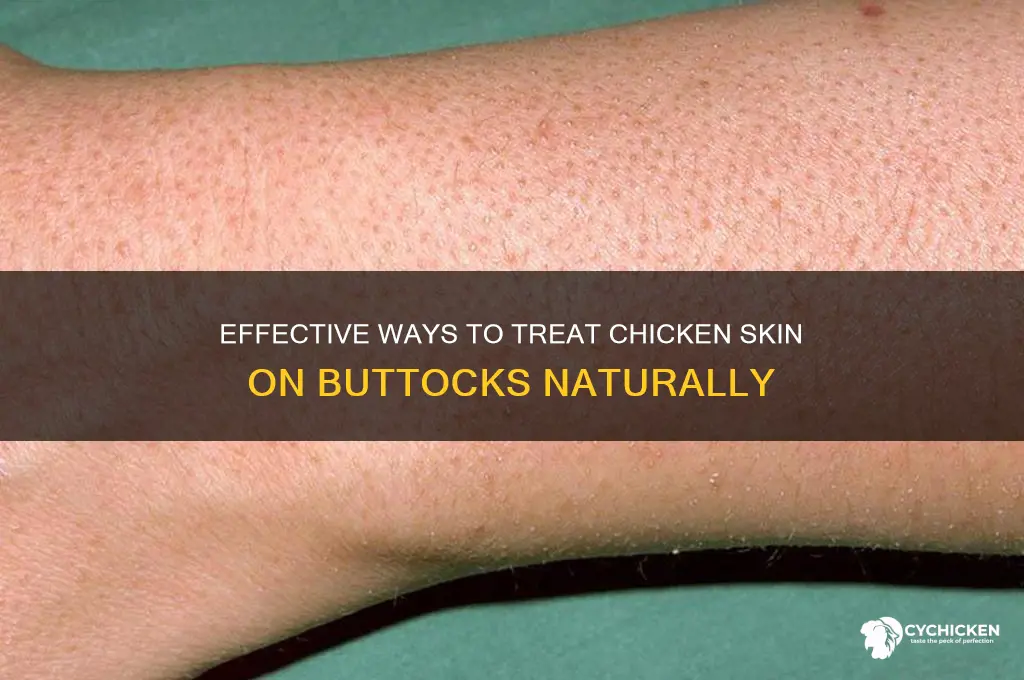 how to treat chicken skin on buttocks
