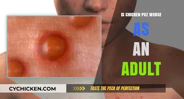 Chickenpox in Adulthood: Why It's More Severe Than Childhood Cases