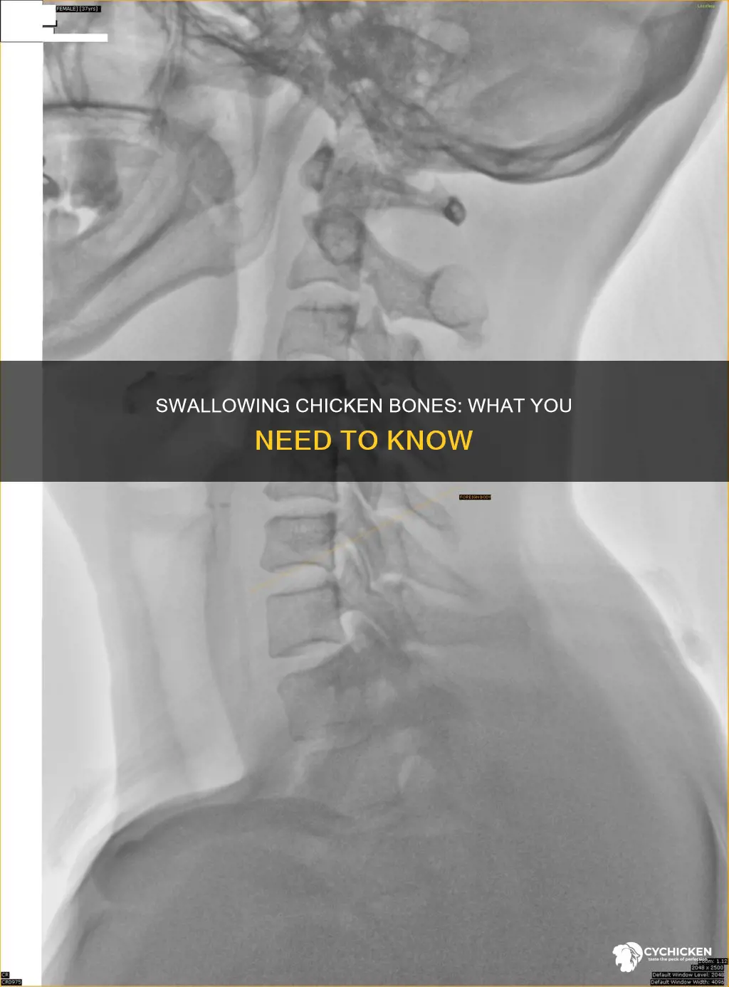 is it ok to swallow a small chicken bone