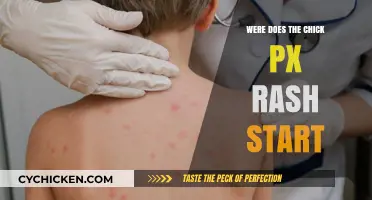 Where Does the Chick Pox Rash Begin and Spread?