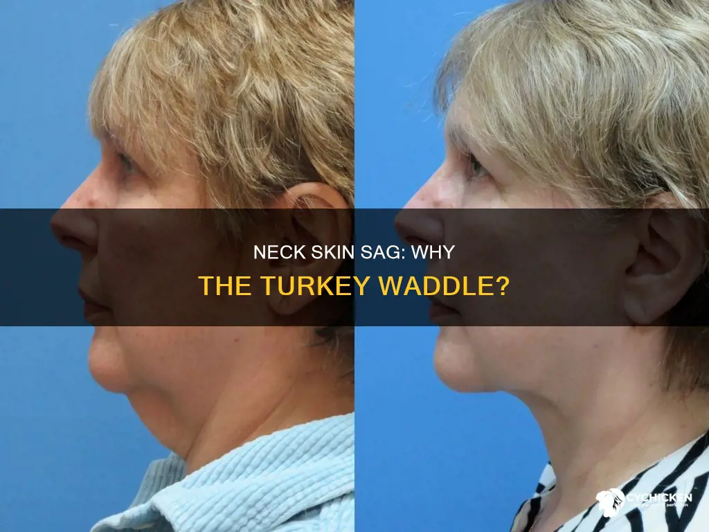 what causes skin beneath neck to sag chicken neck