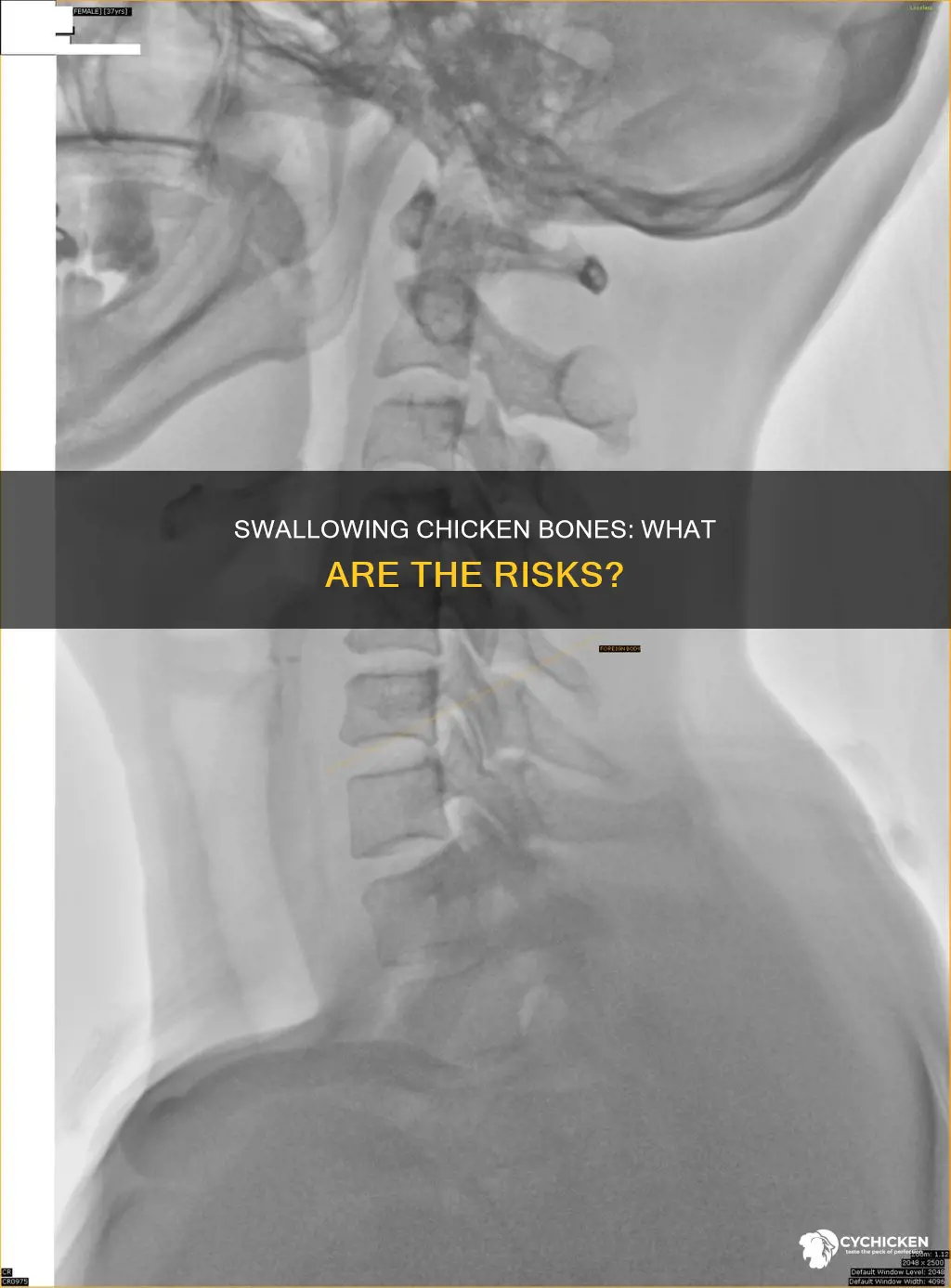 what happens if a human swallows a chicken bone