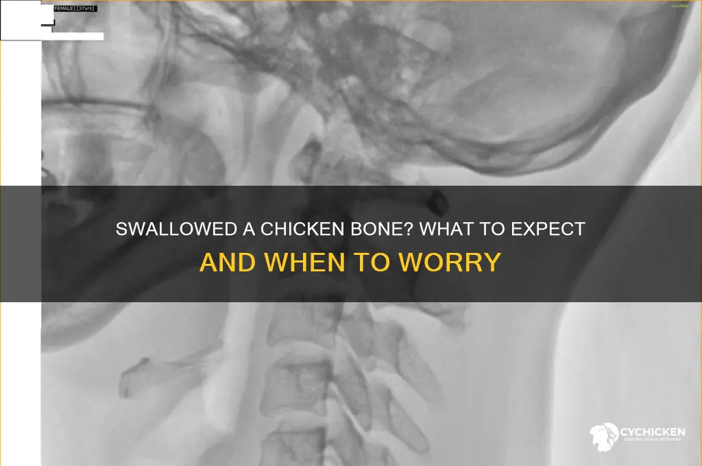 what happens if you swallow chicken bone