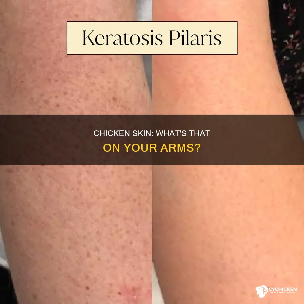 what is the condition onyour arms thats call chicken skin