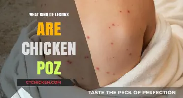 Understanding Chickenpox Lesions: Types, Symptoms, and Treatment Explained