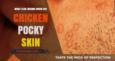 Understanding Chickenpox Skin Lesions: Symptoms, Care, and Recovery Process