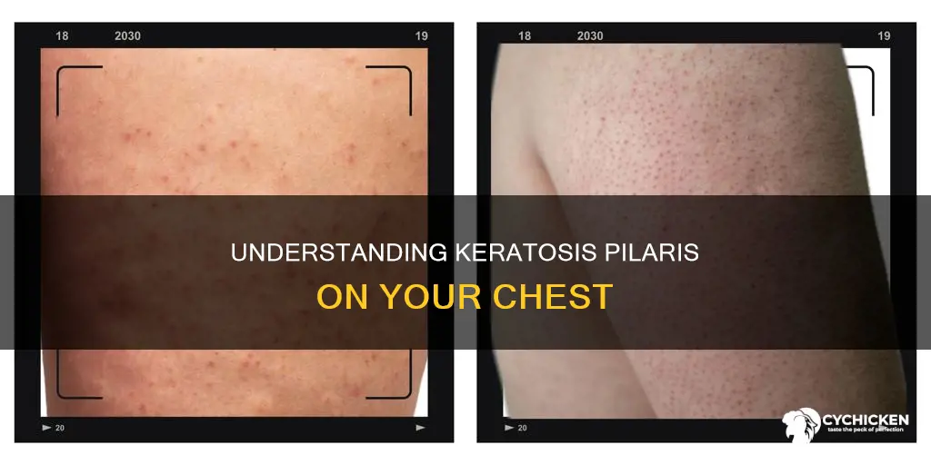 why do i have chicken skin on my chest